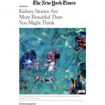 Image showing Polymorphic Crystals of Human Kidney Stone featured in the New York Times published in a Scientific Reports manuscript. 