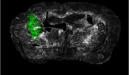 "Ex vivo coronal section of glioma cells, labeled with GFP (green), in a mouse model of glioblastoma (GBM) on day 14 of tumor development."